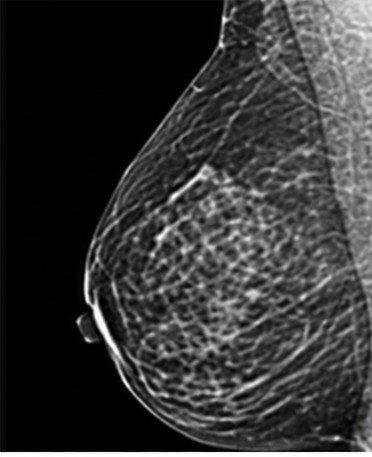 Mammography image, 2D flattened view
