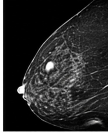 Breast MRI, functional imaging