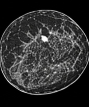QTI scan, true 3D imaging from nipple to chest wall