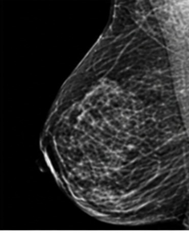 3D mammography with tomosynthesis, layered imaging