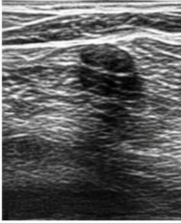 Handheld ultrasound image, limited field of view