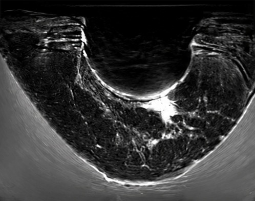 QTI speed of sound image showing ductal carcinoma with a silicone implant, first view