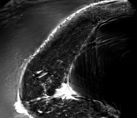 QTI speed of sound image showing ductal carcinoma with a silicone implant, second view