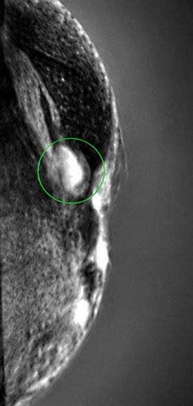 QTI speed of sound image showing lobular carcinoma beside a silicone implant